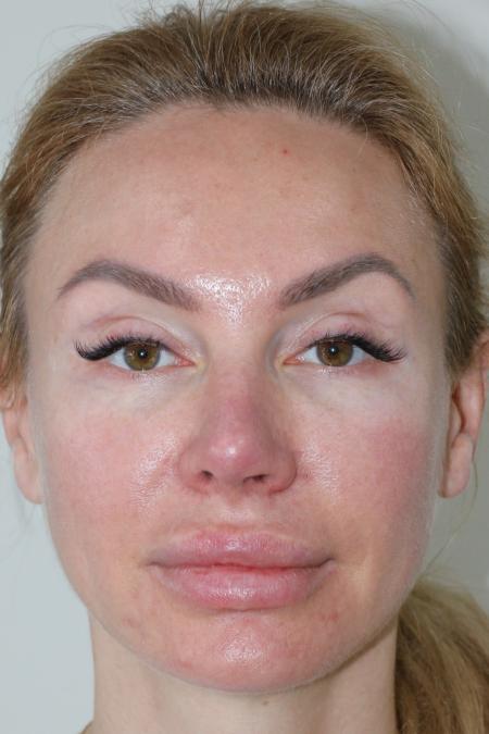 After Case #122396 - Revision Rhinoplasty  After Case #122396 - Revision Rhinoplasty