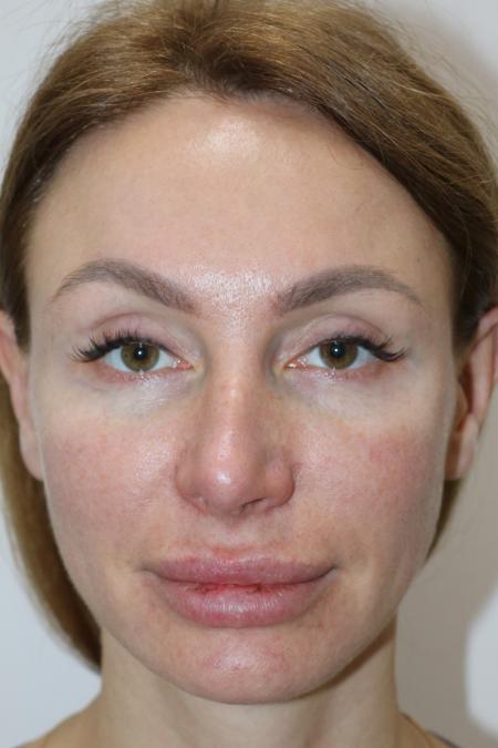 Before Case #122396 - Revision Rhinoplasty  Before Case #122396 - Revision Rhinoplasty