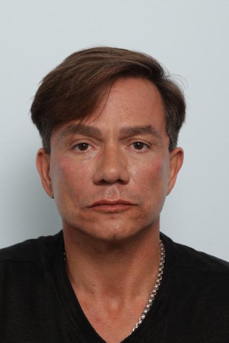 After image 1 Case #125846 - Facelift After image 1 Case #125846 - Facelift