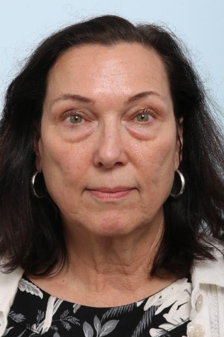 Before image 1 Case #125911 - Upper and Lower Blepharoplasty Before image 1 Case #125911 - Upper and Lower Blepharoplasty