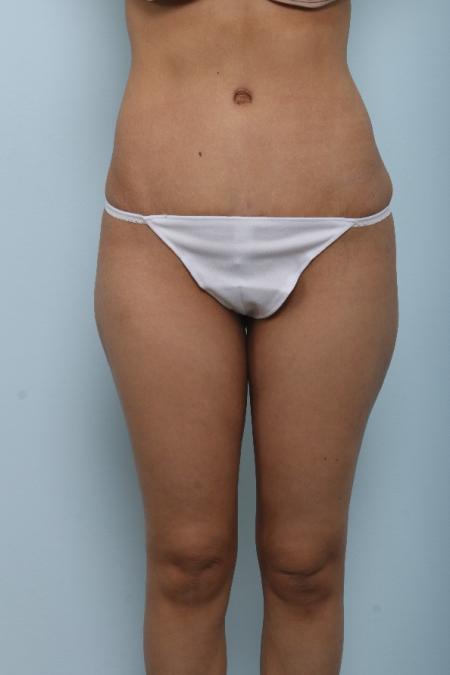 After image 1 Case #125991 - Tummy Tuck After image 1 Case #125991 - Tummy Tuck