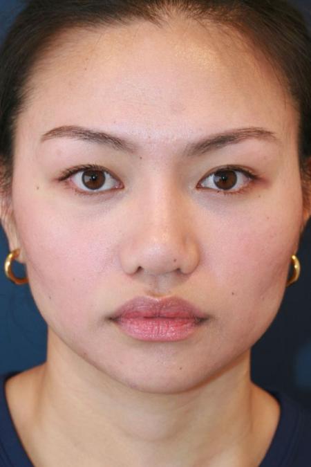 After image 1 Case #125676 - Open Rhinoplasty After image 1 Case #125676 - Open Rhinoplasty