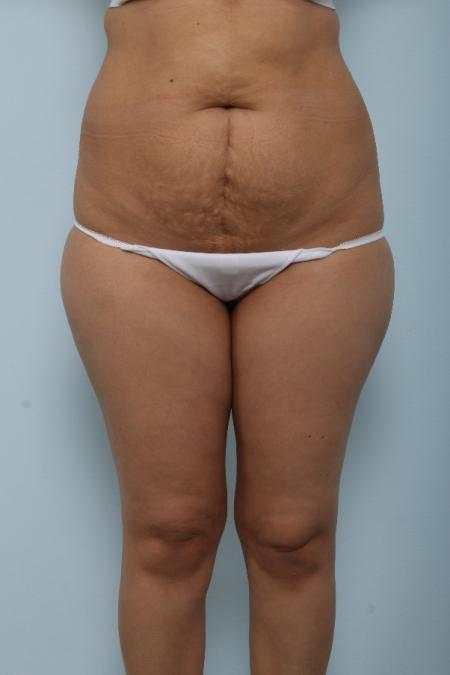Before image 1 Case #125991 - Tummy Tuck Before image 1 Case #125991 - Tummy Tuck