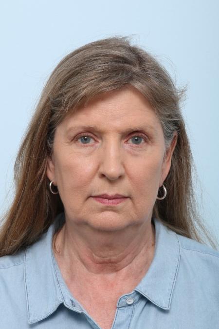 Before image 1 Case #125861 - Facelift Before image 1 Case #125861 - Facelift