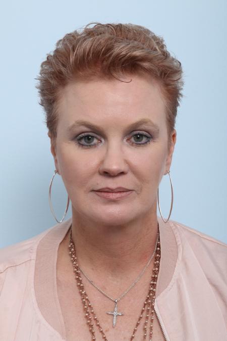 After image 1 Case #125906 - Upper Lip Lift After image 1 Case #125906 - Upper Lip Lift