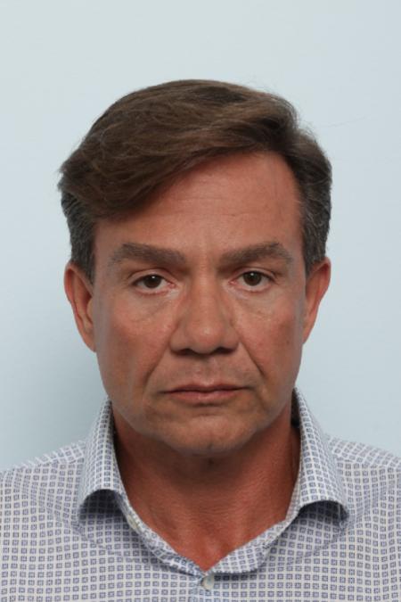 Before image 1 Case #125846 - Facelift Before image 1 Case #125846 - Facelift