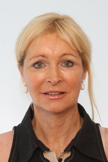 After image 1 Case #125856 - Facelift After image 1 Case #125856 - Facelift