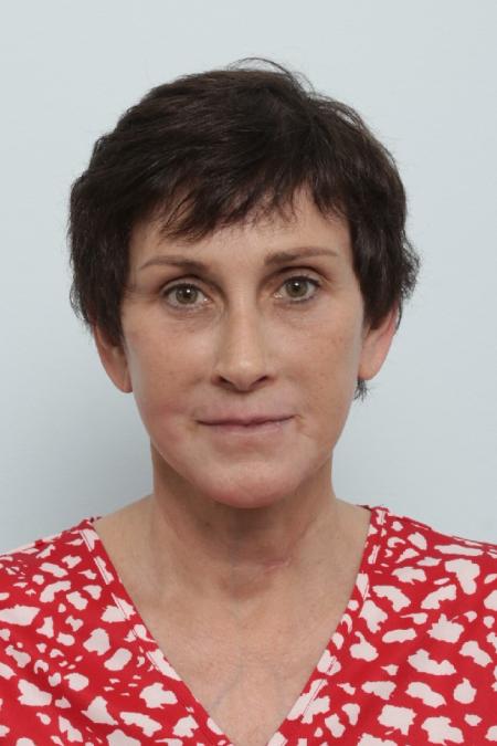 After image 1 Case #125841 - Facelift After image 1 Case #125841 - Facelift