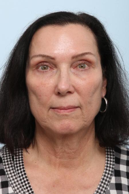 After image 1 Case #125911 - Upper and Lower Blepharoplasty After image 1 Case #125911 - Upper and Lower Blepharoplasty