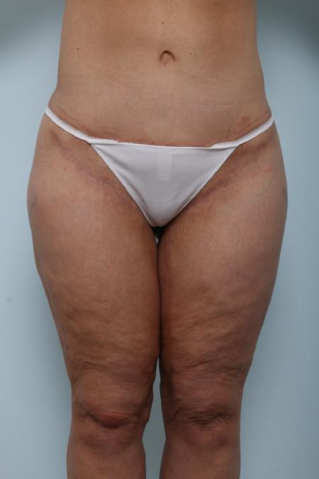 After image 1 Case #125981 - Thigh Lift After image 1 Case #125981 - Thigh Lift