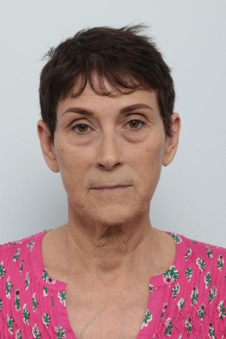 Before image 1 Case #125841 - Facelift Before image 1 Case #125841 - Facelift