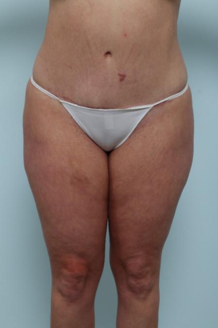 After image 1 Case #125956 - Tummy Tuck After image 1 Case #125956 - Tummy Tuck