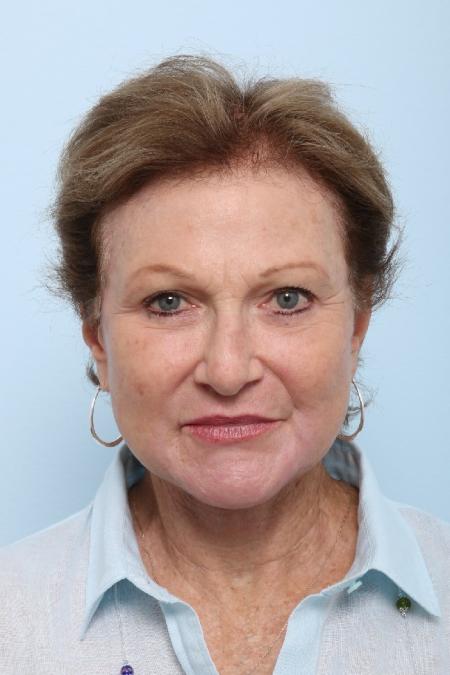 After image 1 Case #125851 - Facelift After image 1 Case #125851 - Facelift