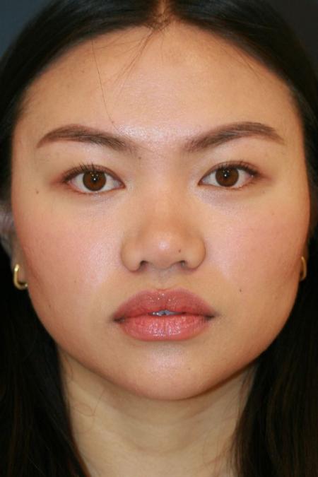 Before image 1 Case #125676 - Open Rhinoplasty Before image 1 Case #125676 - Open Rhinoplasty