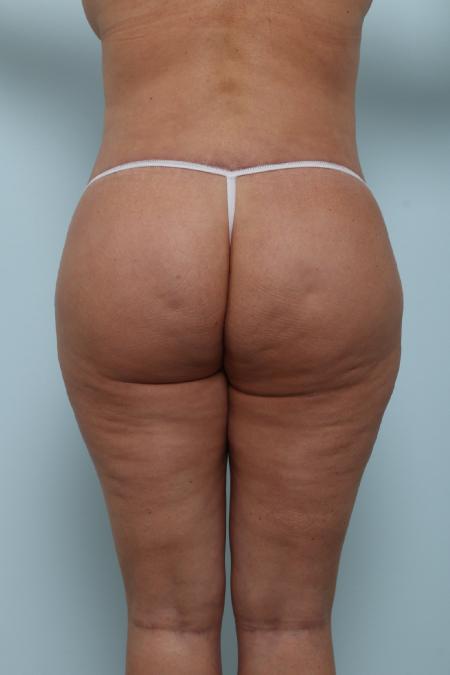 After image 1 Case #125951 - Back Lift After image 1 Case #125951 - Back Lift