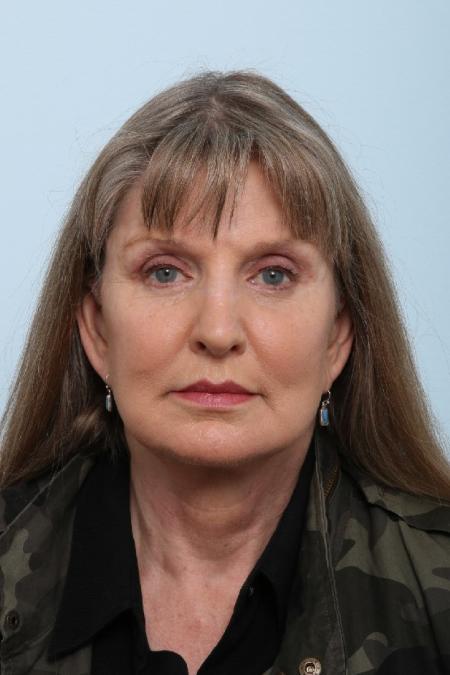 After image 1 Case #125861 - Facelift After image 1 Case #125861 - Facelift