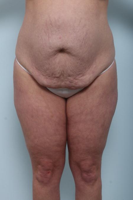 Before image 1 Case #125956 - Tummy Tuck Before image 1 Case #125956 - Tummy Tuck