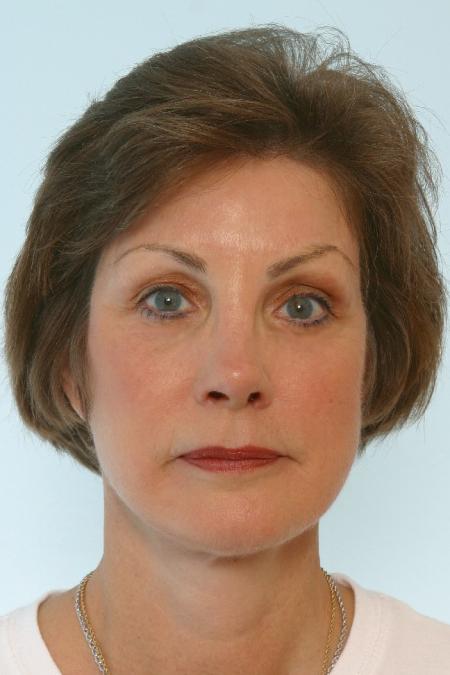 After image 1 Case #125866 - Facelift After image 1 Case #125866 - Facelift