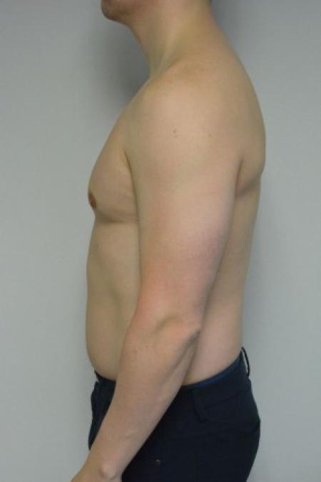 Gynecomastia Before & After, Case 10, Male, age 25 – 34
