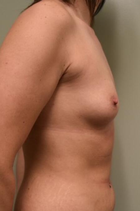 Before image 3 Case #86846 - Submuscular Breast Augmentation with Soft Touch Round Cohesive Silicone Implants