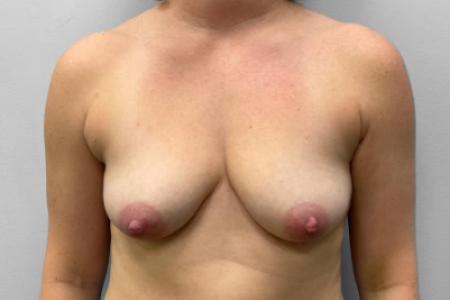 Before Case #114876 - Breast Augmentation