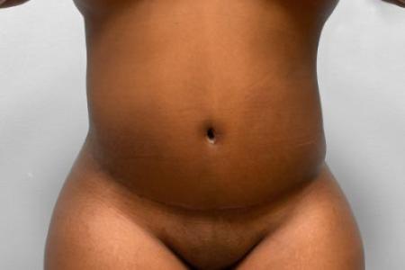 After image 1 Case #115221 - Tummy Tuck & 360 Liposuction