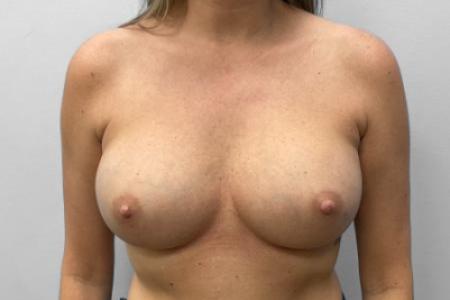Before Case #114881 - Breast Implant Exchange