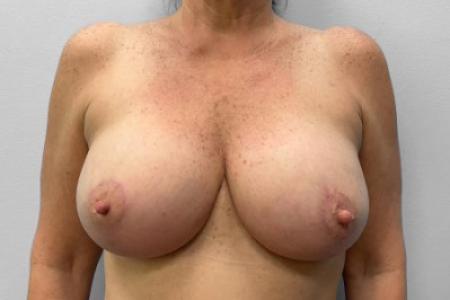 After Case #114866 - Breast Implant Exchange