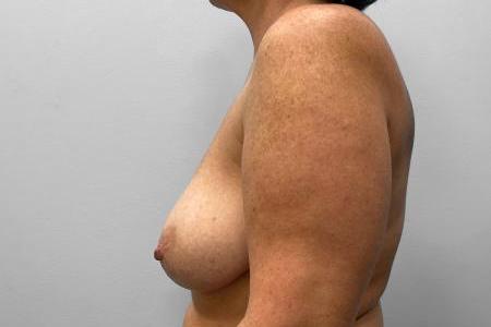 Before image 3 Case #114966 - Breast Reduction & Lift