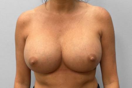 After Case #114881 - Breast Implant Exchange