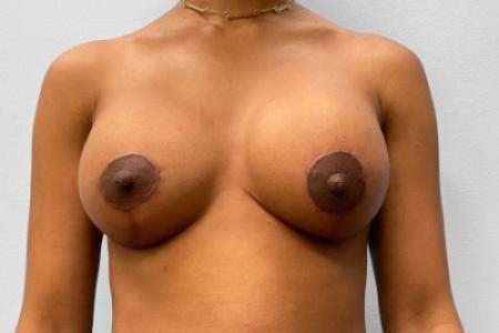 After image 1 Case #114971 - Breast Implant Revision & Lift