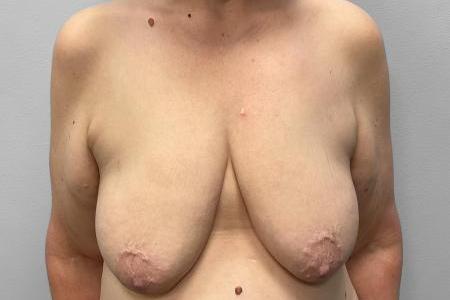Before image 1 Case #115726 - Breast Augmentation & Lift