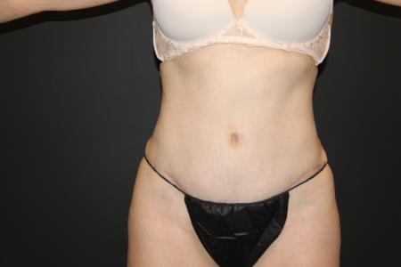 After image 1 Case #115486 - Abdominoplasty