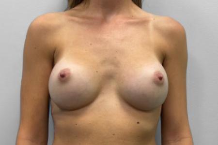 After image 1 Case #115541 - Breast Augmentation