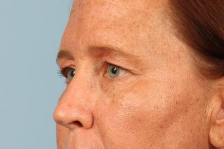 Before image 2 Case #116506 - Upper Eyelid Contouring