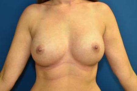 After image 1 Case #116081 - Breast Augmentation