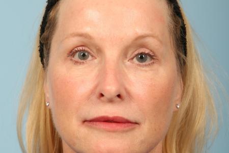 After image 1 Case #116496 - Upper Eyelid Contouring