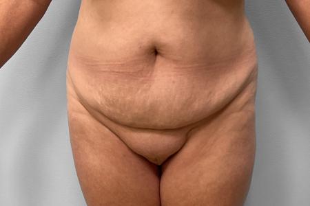 Before image 1 Case #116866 - Tummy Tuck & Lipo