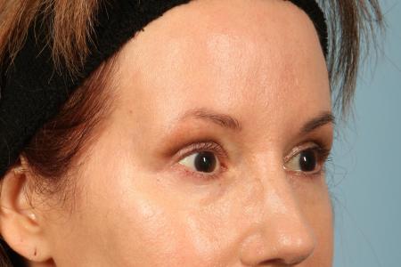 After image 2 Case #116486 - Upper Eyelid Contouring