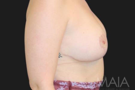 After image 3 Case #116821 - 31 year-old patient | Breast Reduction 