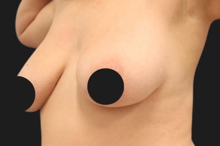 Before Case #116791 - 42 year-old patient | Breast Lift 