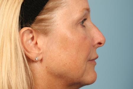 After image 3 Case #116496 - Upper Eyelid Contouring