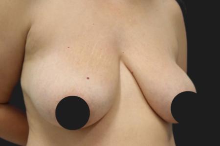 Before Case #116791 - 42 year-old patient | Breast Lift 