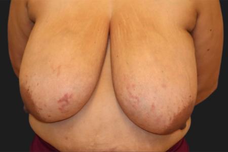 Before image 1 Case #116816 - 55 year-old patient | Breast Reduction