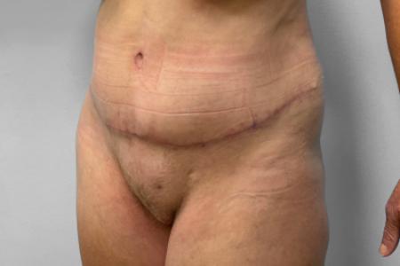 After image 2 Case #116866 - Tummy Tuck & Lipo