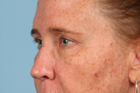 After image 2 Case #116506 - Upper Eyelid Contouring