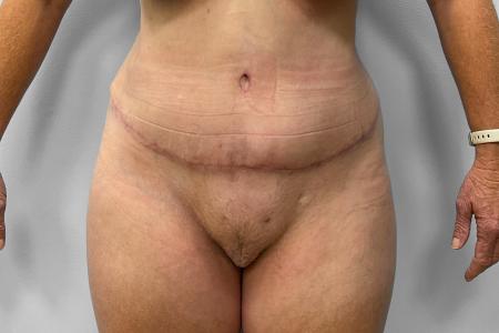 After image 1 Case #116866 - Tummy Tuck & Lipo