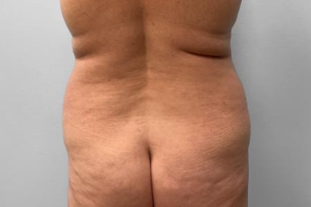 Before image 4 Case #116866 - Tummy Tuck & Lipo