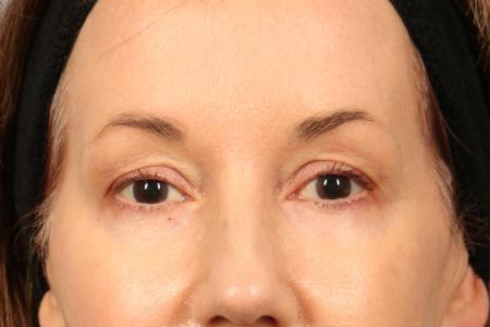 Before image 1 Case #116486 - Upper Eyelid Contouring