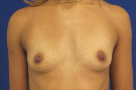 Before image 1 Case #116776 - 30 year-old patient | Breast Augmentation